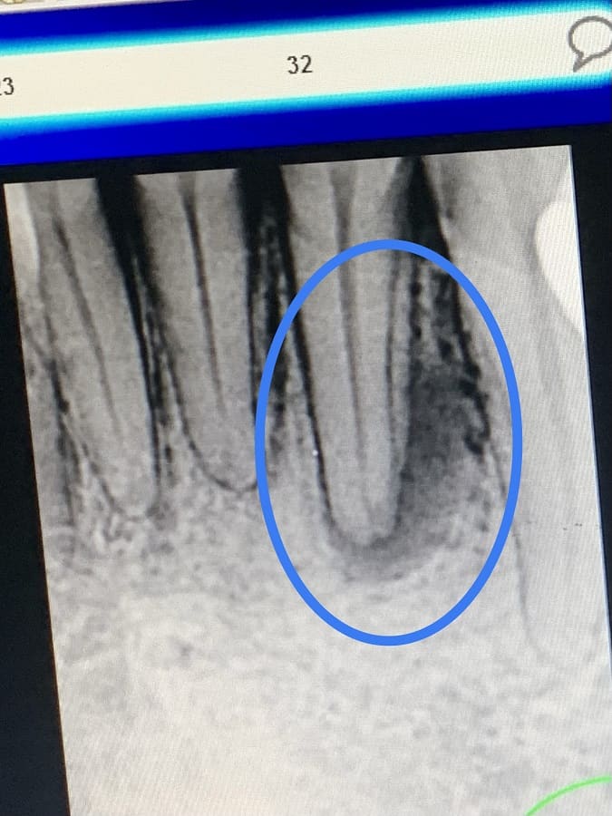 x-ray of the infection under ellen's tooth that caused the emergency root canal in riskikesh